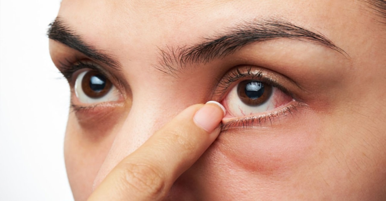 গরমে চোখের যত রোগ