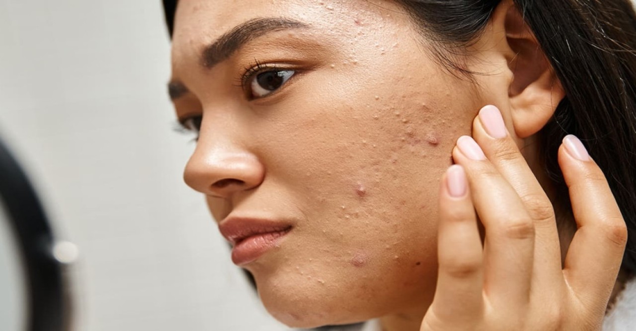 মানসিক চাপ থেকে হতে পারে ব্রণ, জানুন করণীয়