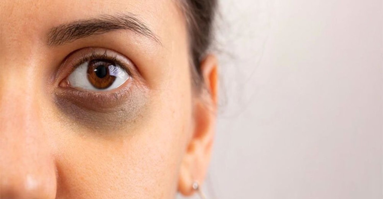 যে তিন জিনিসে দূর হবে চোখের নিচের কালো দাগ