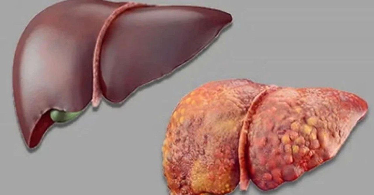 লিভারের ক্ষতি রোধ হবে যে খাবারে, জানাল গবেষণা